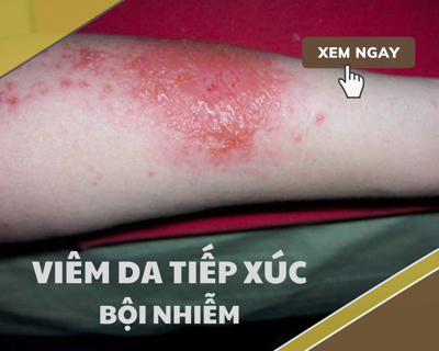 Viêm da tiếp xúc bội nhiễm: Nguyên nhân và cách điều trị 